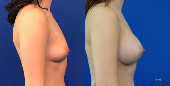 Before & After Breast Augmentation Case 147 View #5 View in Fort Worth & Arlington, Texas