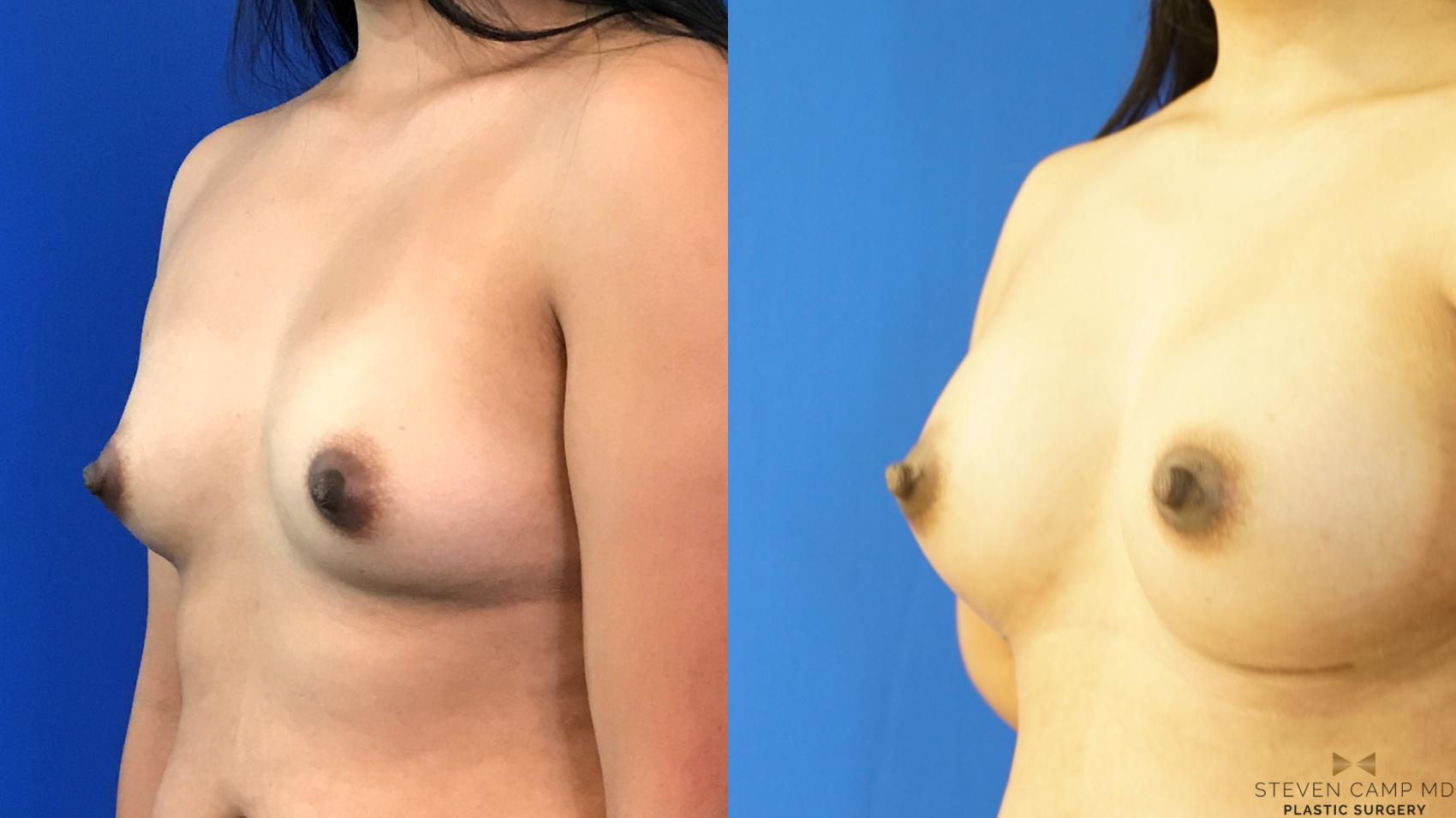 Before & After Breast Augmentation Case 151 View #1 View in Fort Worth, Texas