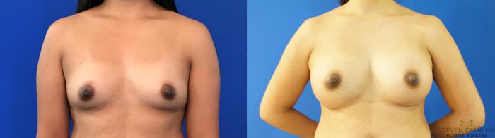 Before & After Breast Augmentation Case 151 View #2 View in Fort Worth, Texas