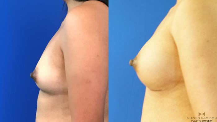 Before & After Breast Augmentation Case 151 View #3 View in Fort Worth, Texas