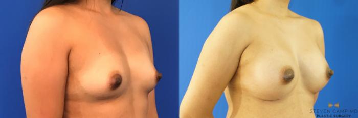 Before & After Breast Augmentation Case 151 View #4 View in Fort Worth, Texas