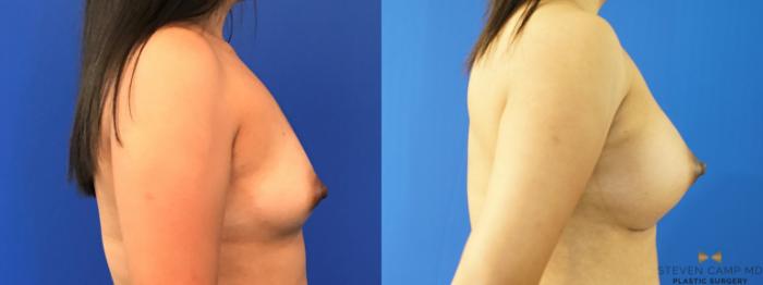 Before & After Breast Augmentation Case 151 View #5 View in Fort Worth, Texas