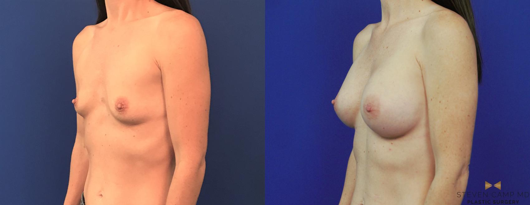 Before & After Breast Augmentation Case 153 View #1 View in Fort Worth, Texas