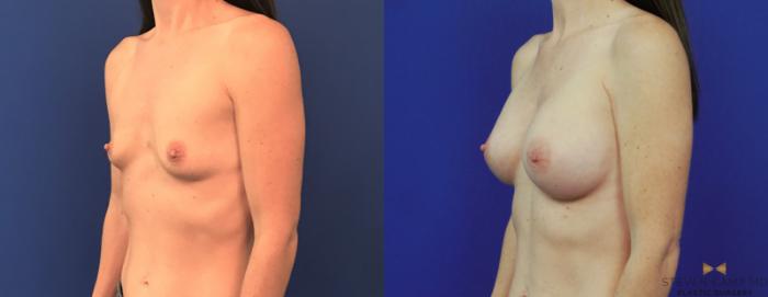 Before & After Breast Augmentation Case 153 View #1 View in Fort Worth, Texas