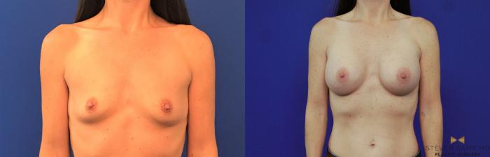 Before & After Breast Augmentation Case 153 View #2 View in Fort Worth & Arlington, Texas