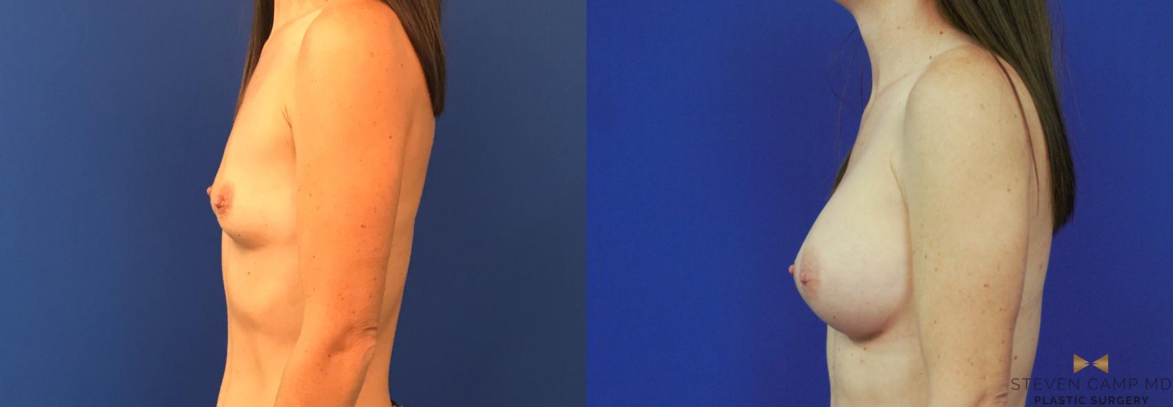 Before & After Breast Augmentation Case 153 View #3 View in Fort Worth, Texas