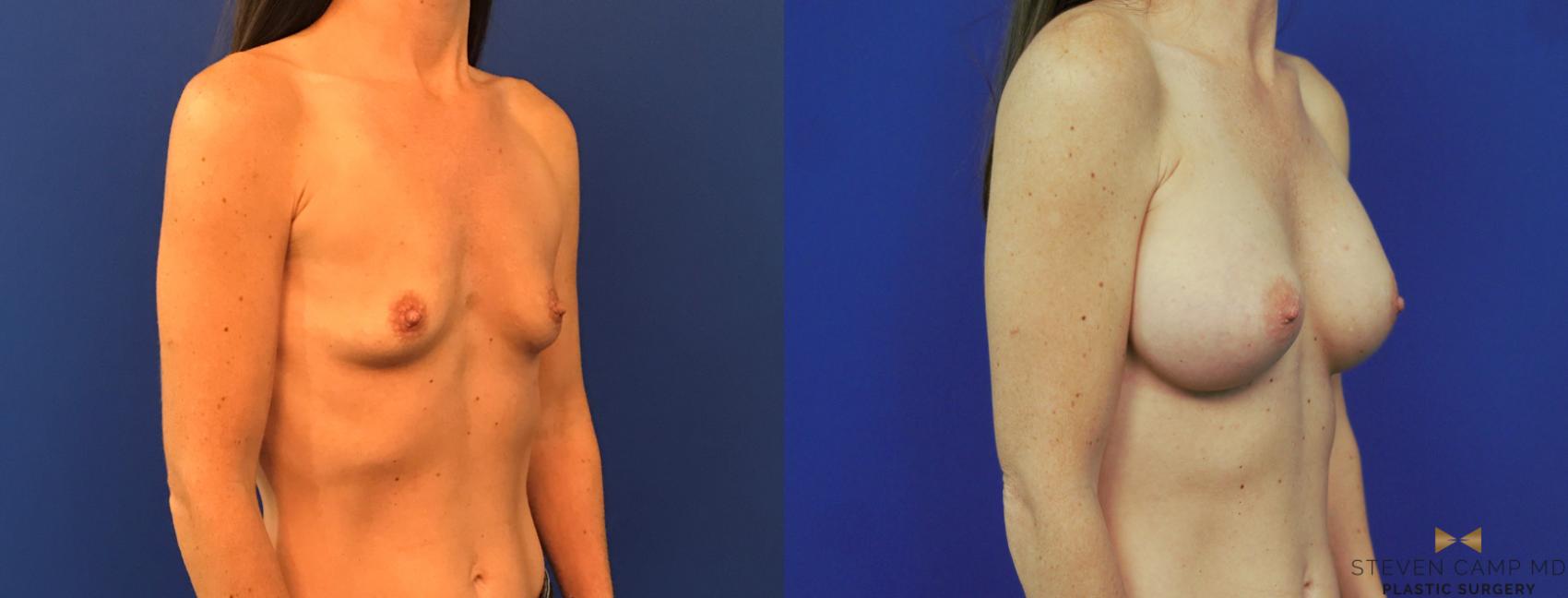 Before & After Breast Augmentation Case 153 View #4 View in Fort Worth, Texas