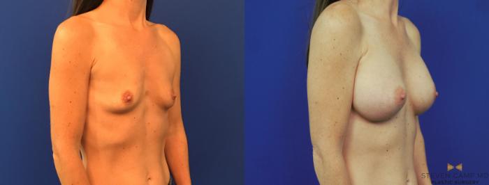 Before & After Breast Augmentation Case 153 View #4 View in Fort Worth & Arlington, Texas