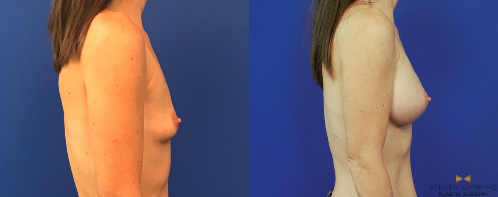 Before & After Breast Augmentation Case 153 View #5 View in Fort Worth & Arlington, Texas