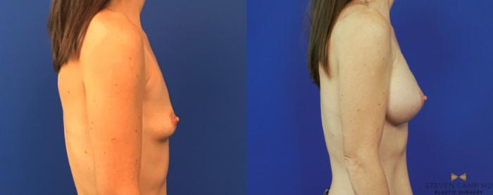 Before & After Breast Augmentation Case 153 View #5 View in Fort Worth & Arlington, Texas