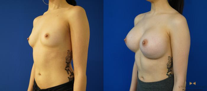 Before & After Breast Augmentation Case 155 View #1 View in Fort Worth & Arlington, Texas