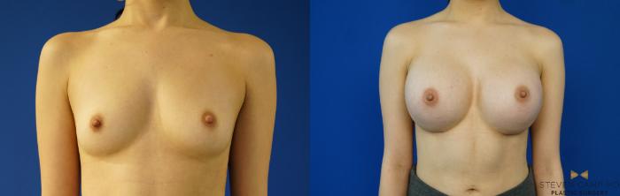 Before & After Breast Augmentation Case 155 View #2 View in Fort Worth & Arlington, Texas
