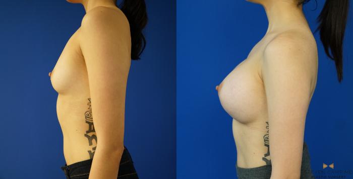 Before & After Breast Augmentation Case 155 View #3 View in Fort Worth & Arlington, Texas