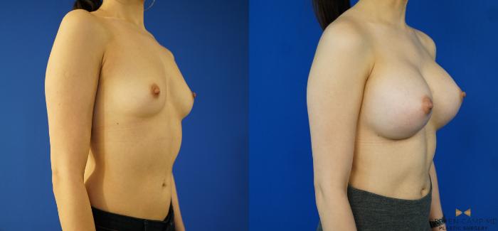 Before & After Breast Augmentation Case 155 View #4 View in Fort Worth & Arlington, Texas