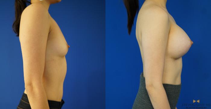 Before & After Breast Augmentation Case 155 View #5 View in Fort Worth & Arlington, Texas