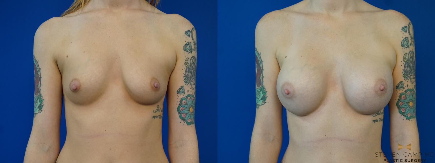 Before & After Breast Augmentation Case 157 View #1 View in Fort Worth, Texas