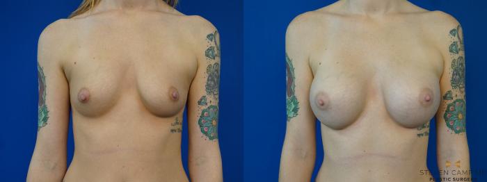 Before & After Breast Augmentation Case 157 View #1 View in Fort Worth, Texas