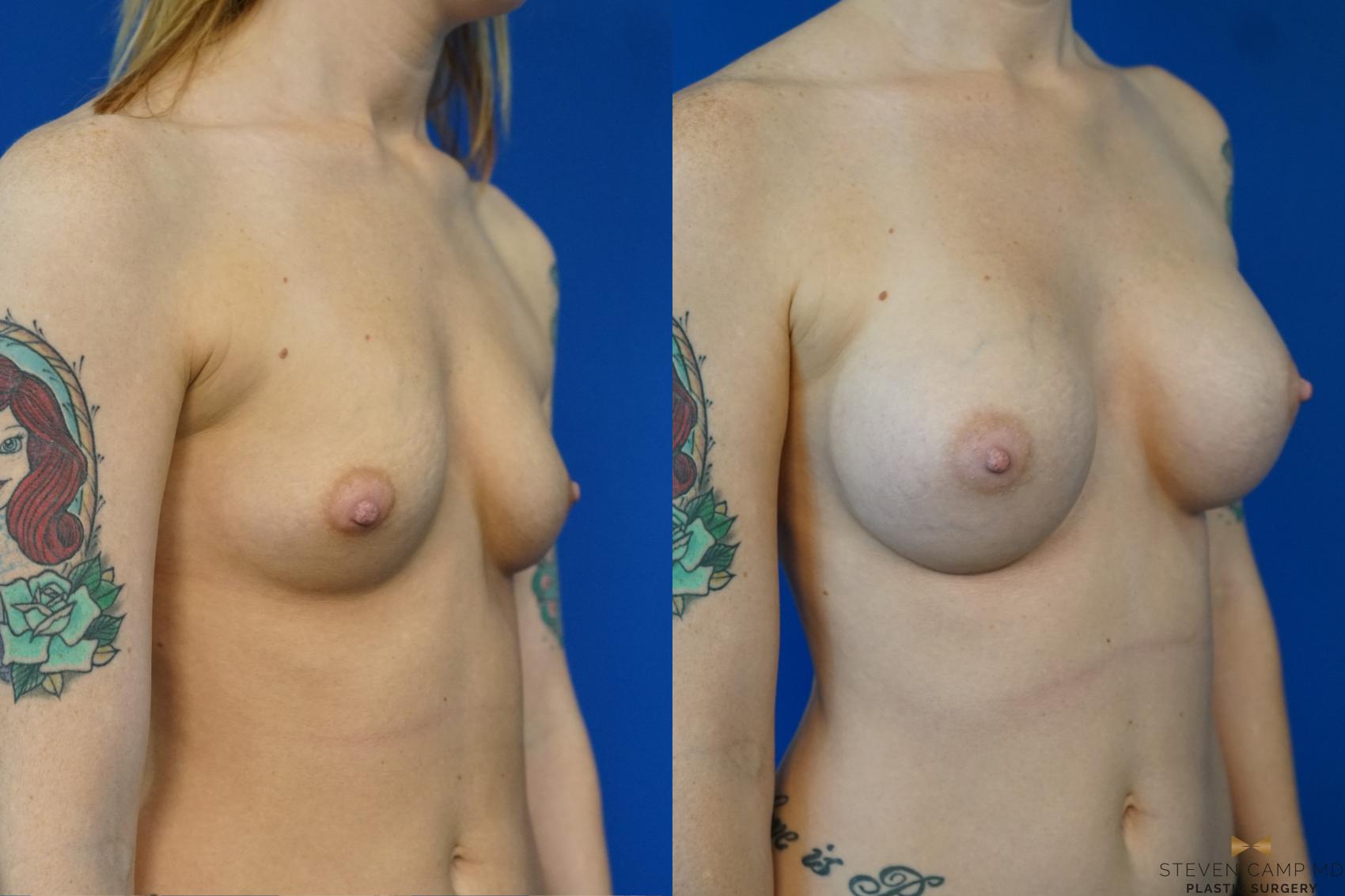 Before & After Breast Augmentation Case 157 View #4 View in Fort Worth, Texas