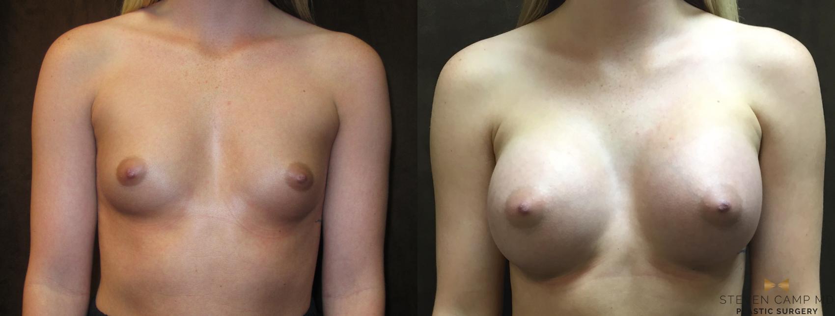 Before & After Case2903 by Steven Camp MD Plastic Surgery & Aesthetics, in Fort Worth