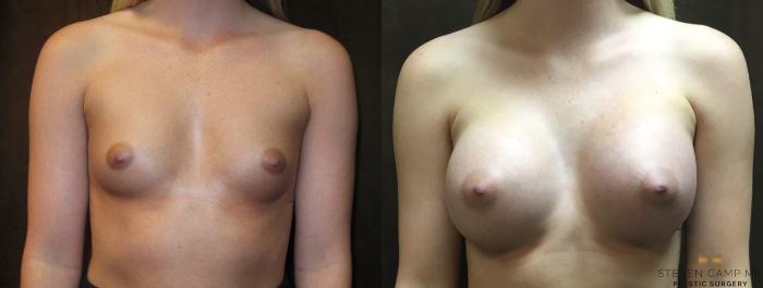 Before & After Breast Augmentation Case 19 View #1 View in Fort Worth, Texas