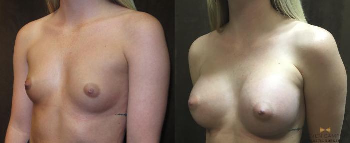 Before & After Breast Augmentation Case 19 View #2 View in Fort Worth, Texas