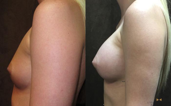 Before & After Breast Augmentation Case 19 View #3 View in Fort Worth, Texas