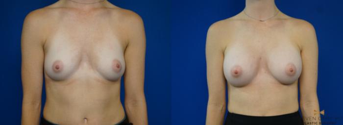 Before & After Breast Augmentation Case 194 View #1 View in Fort Worth & Arlington, Texas