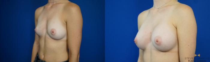 Before & After Breast Augmentation Case 194 View #2 View in Fort Worth & Arlington, Texas
