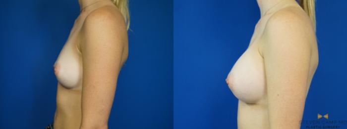 Before & After Breast Augmentation Case 194 View #3 View in Fort Worth & Arlington, Texas