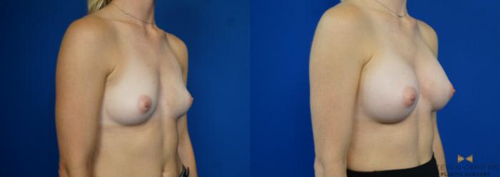Before & After Breast Augmentation Case 194 View #4 View in Fort Worth & Arlington, Texas