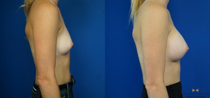 Before & After Breast Augmentation Case 194 View #5 View in Fort Worth & Arlington, Texas
