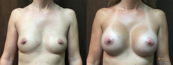 Before & After Breast Augmentation Case 21 View #1 View in Fort Worth, Texas