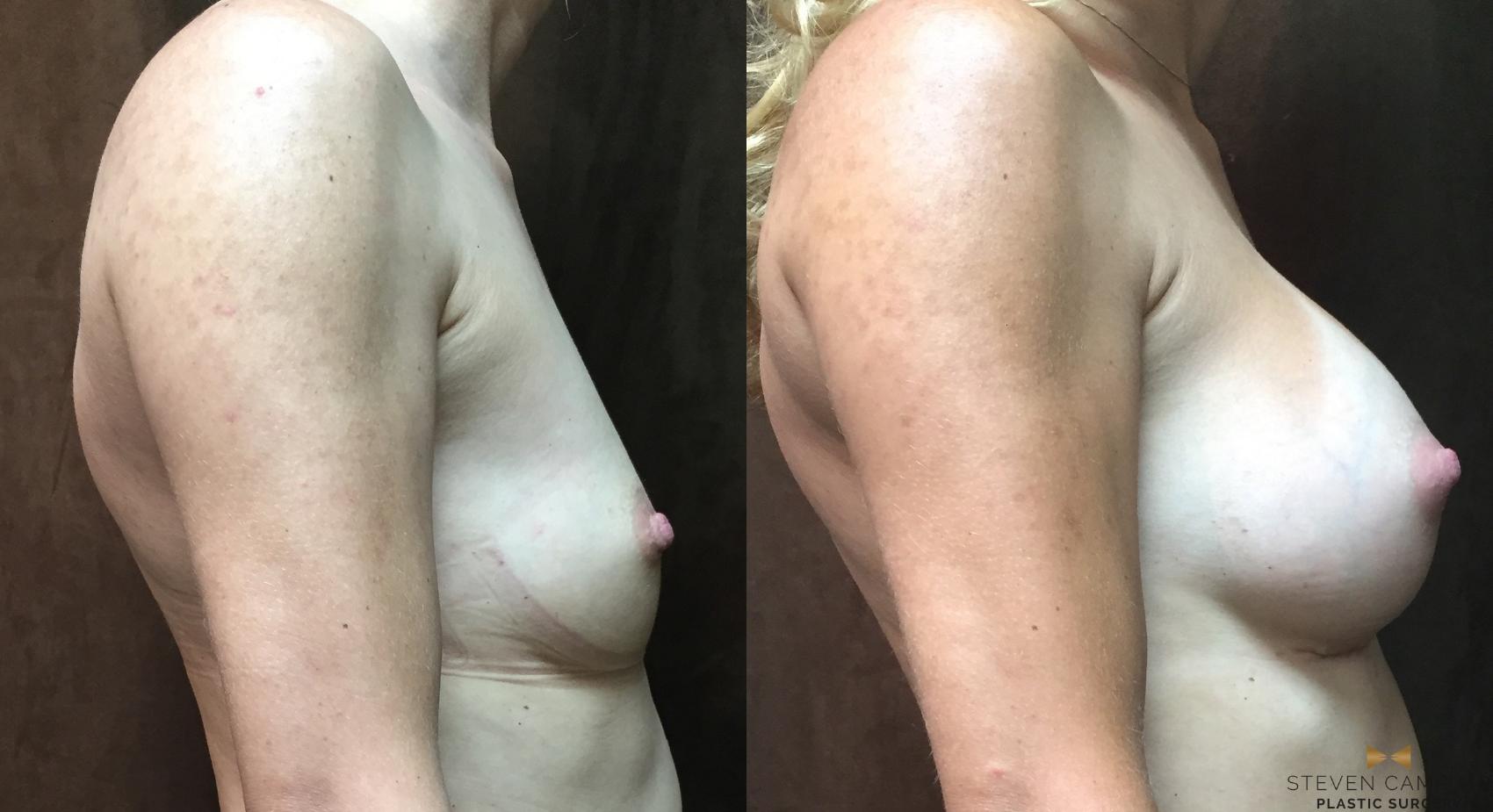 Before & After Breast Augmentation Case 21 View #2 View in Fort Worth, Texas