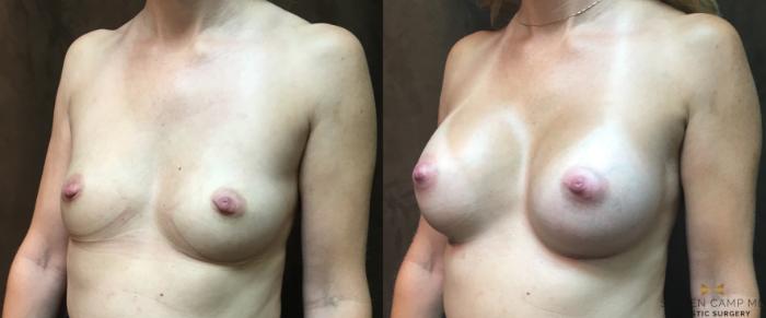 Before & After Breast Augmentation Case 21 View #3 View in Fort Worth, Texas