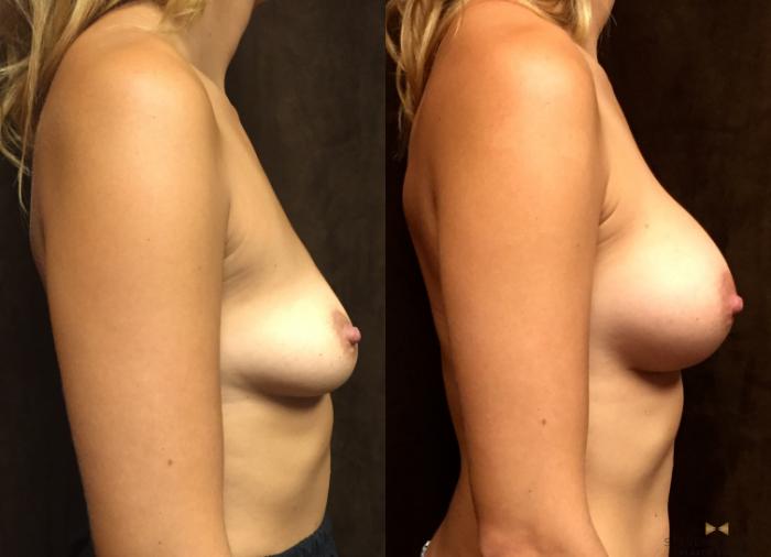 Before & After Breast Augmentation Case 22 View #5 View in Fort Worth, Texas