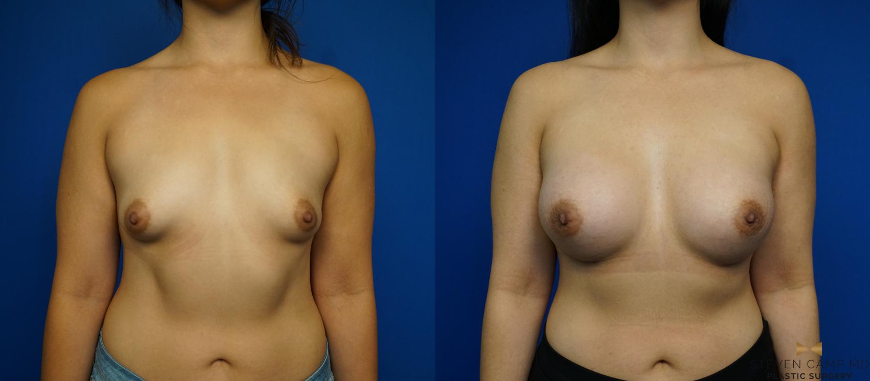 Before & After Breast Augmentation Case 226 View #1 View in Fort Worth & Arlington, Texas