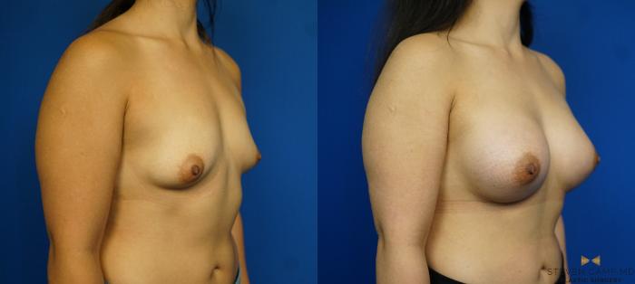 Before & After Breast Augmentation Case 226 View #2 View in Fort Worth & Arlington, Texas