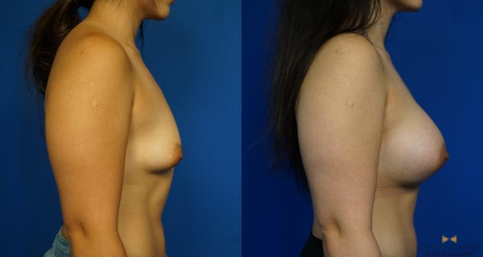 Before & After Breast Augmentation Case 226 View #3 View in Fort Worth & Arlington, Texas