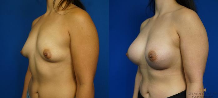 Before & After Breast Augmentation Case 226 View #4 View in Fort Worth & Arlington, Texas