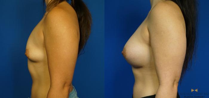 Before & After Breast Augmentation Case 226 View #5 View in Fort Worth & Arlington, Texas