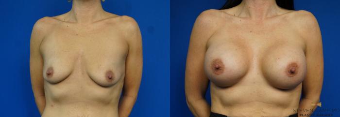Before & After Breast Augmentation Case 227 View #1 View in Fort Worth & Arlington, Texas