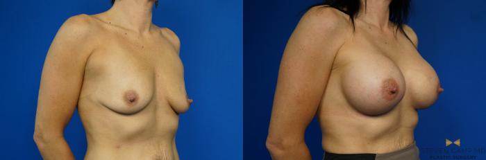 Before & After Breast Augmentation Case 227 View #2 View in Fort Worth & Arlington, Texas