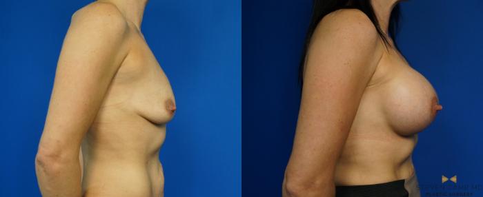 Before & After Breast Augmentation Case 227 View #3 View in Fort Worth & Arlington, Texas