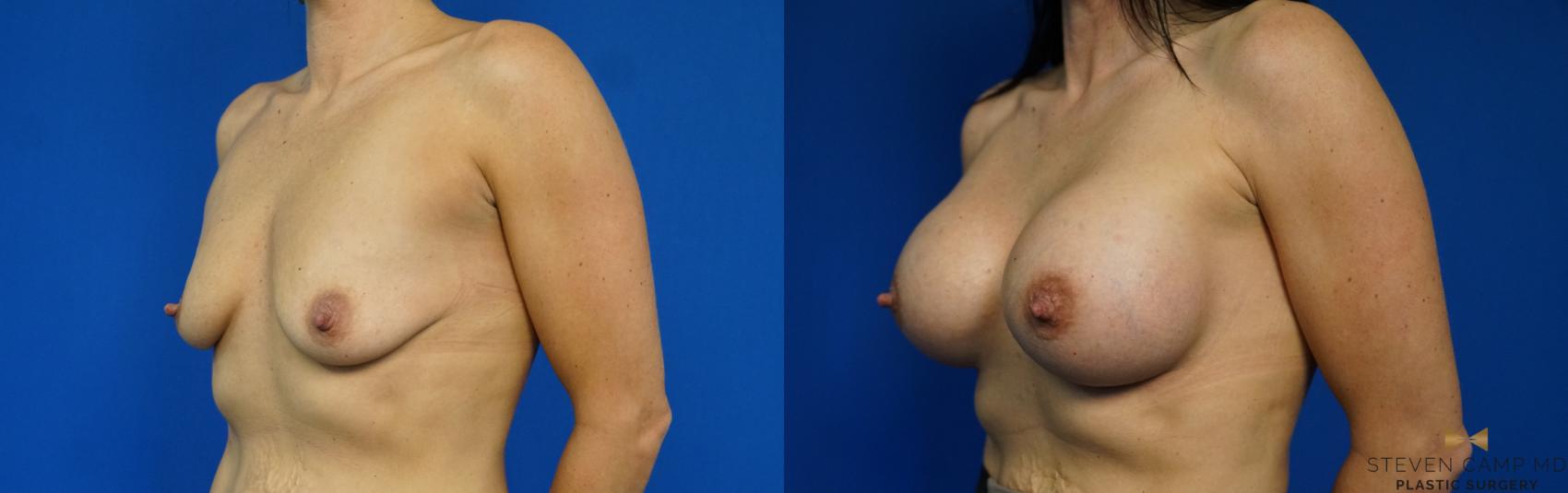 Before & After Breast Augmentation Case 227 View #4 View in Fort Worth & Arlington, Texas