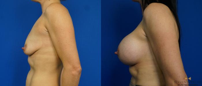 Before & After Breast Augmentation Case 227 View #5 View in Fort Worth & Arlington, Texas