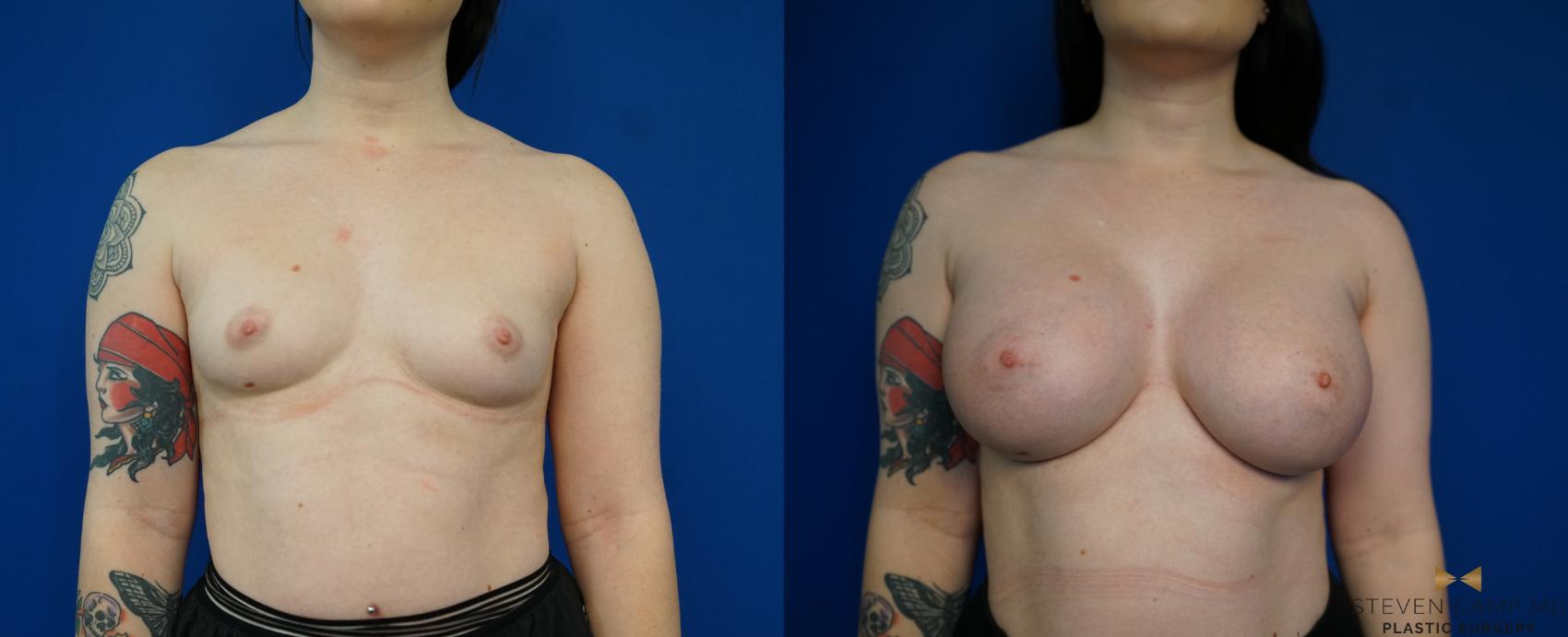 Before & After Breast Augmentation Case 229 View #1 View in Fort Worth & Arlington, Texas