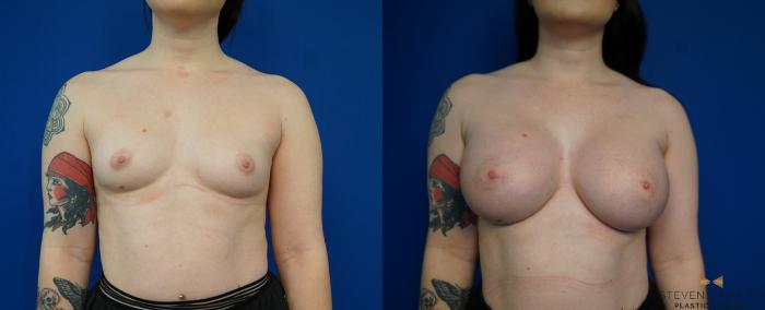 Before & After Breast Augmentation Case 229 View #1 View in Fort Worth & Arlington, Texas