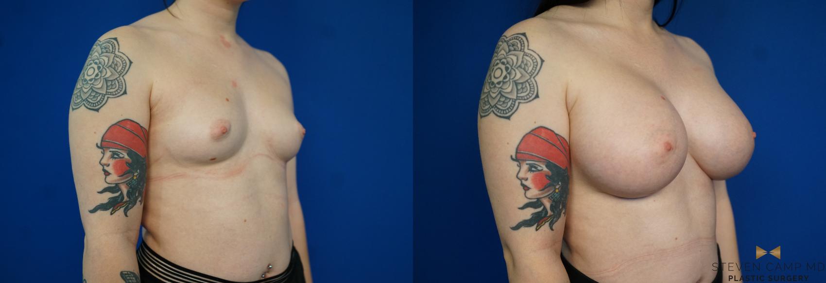 Before & After Breast Augmentation Case 229 View #2 View in Fort Worth & Arlington, Texas