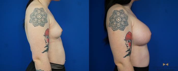 Before & After Breast Augmentation Case 229 View #3 View in Fort Worth & Arlington, Texas