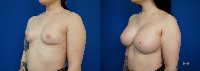 Before & After Breast Augmentation Case 229 View #4 View in Fort Worth & Arlington, Texas